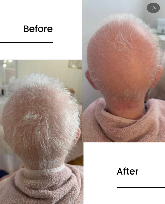 ✨ INTRODUCING OUR NEW HAIR GROWTH MICRONEEDLING TREATMENT ✨

Struggling with thinning hair, slow regrowth, or areas that just won’t fill in? We’re so excited to launch our newest advanced treatment designed to stimulate natural hair growth from the root up.

Our innovative procedure uses microneedling technology to create tiny, controlled micro-channels in the epidermis. This allows a powerful, targeted hair growth serum to penetrate deeper into the scalp — where it can work more effectively to nourish follicles and encourage healthy regrowth.

🌱 Stimulates dormant hair follicles
💧 Enhances absorption of growth-boosting serum
✨ Improves scalp health
📈 Supports thicker, fuller-looking hair over time

This treatment is suitable for both men and women experiencing thinning, early hair loss, or post-partum shedding. It’s minimally invasive, with little downtime, and designed to complement your hair restoration journey.

This case study saw these results after just four sessions. 

If you’ve been waiting for a sign to start your regrowth journey — this is it.

📩 Message us to book your consultation and be one of the first to experience a fuller hair line