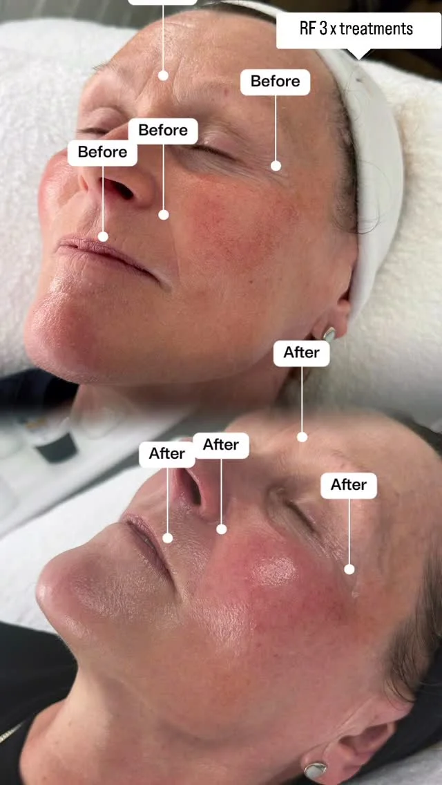 The difference after just THREE radio frequency treatments 🤍✨

Skin feels tighter, smoother, and so much more lifted already — and we’re only halfway through the journey. The before & after speaks for itself 👏

- smoother marionette lines 
- minimised fine lines around the eye 
- smoother between brows 
- less fine lines on the top lip. 

Consistency is everything when it comes to skin treatments, and these results are proof that small steps create big changes.

She still has 3 more sessions to go and we cannot wait to see the final results 😍

#RadioFrequency #SkinTightening #BeforeAndAfter #SkinJourney AestheticTreatments RFTreatment GlowingSkin SkinConfidence BeautyResults